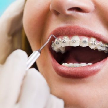 Tratamento de Ortodontia com 50% de desconto na manutenção. Confiram!